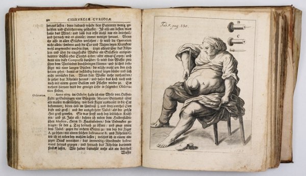 PURMANN Matthäus Gottfried - Matthæi Gothof. Purmanni, Chirurgi und Stadt-Artztes zu Bresslau, Herausgegebene Chirurgia Curiosa, darinnen ein jedweder Chirurgus nicht allein auffs gründlichste sehen und finden kan, was in die gantze Wund-Artzney vor künst