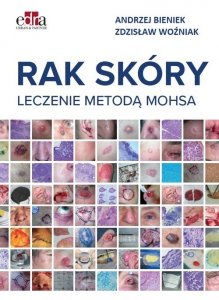 Rak skóry Leczenie metodą Mohsa